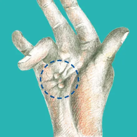 Handchirurgie Hannover Dupuytren’sche Kontraktur