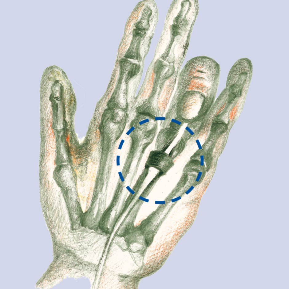 ringband-b ringband-b