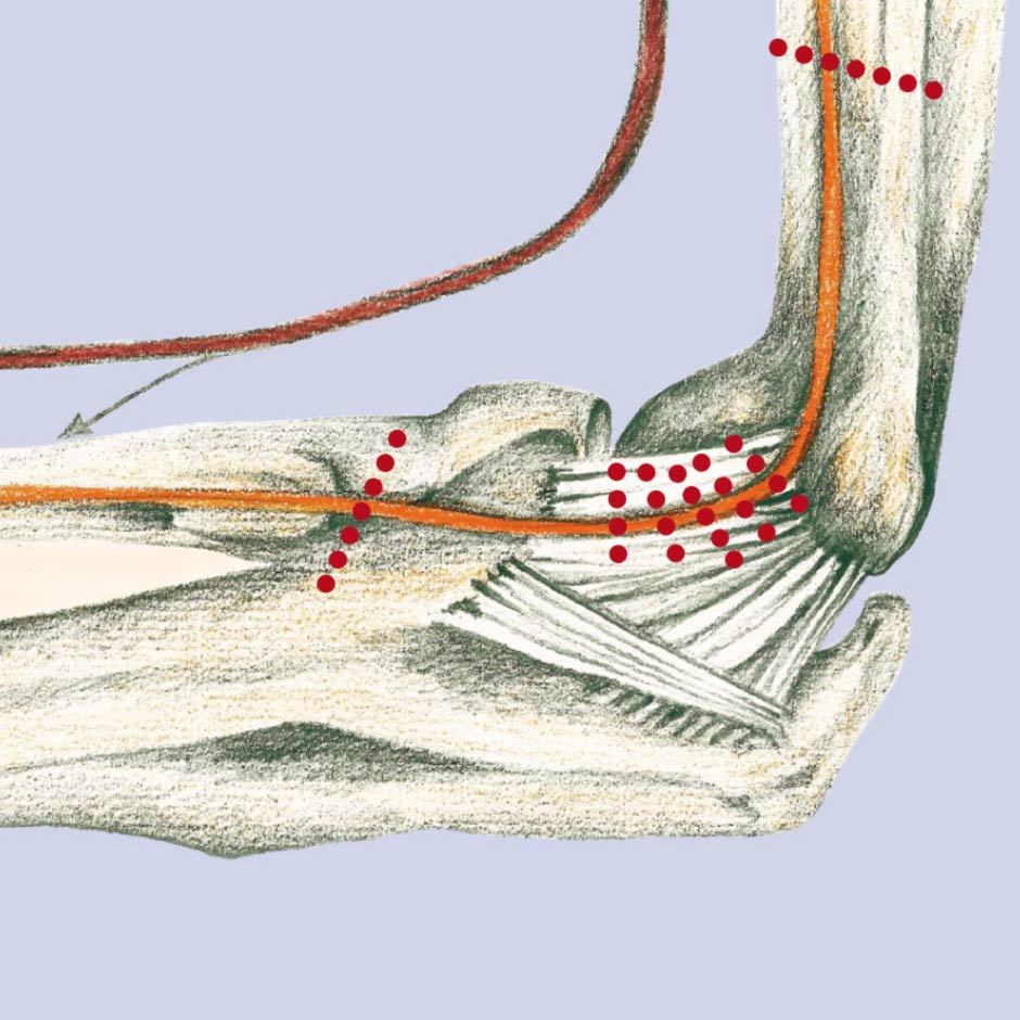 Ulnaris op sulcus lange syndrom krank wie iumsin.net Sulcus