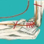 Handchirurgie Hannover Sulcus Ulnaris Syndrom