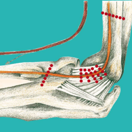 Handchirurgie Hannover Sulcus Ulnaris Syndrom