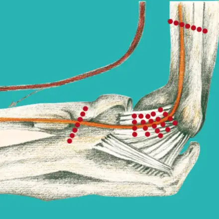 Handchirurgie Hannover Sulcus Ulnaris Syndrom