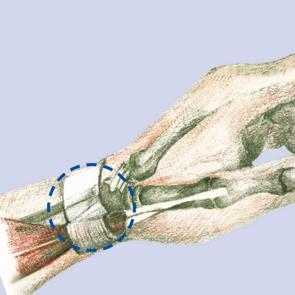 tendovaginitis-b tendovaginitis-b